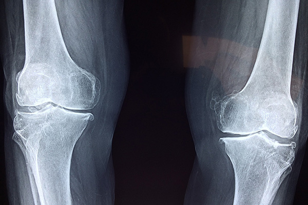 knee-2253047_1280.jpg